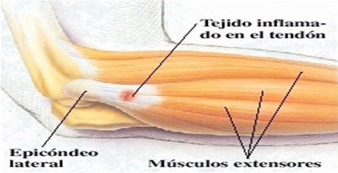 lesiones